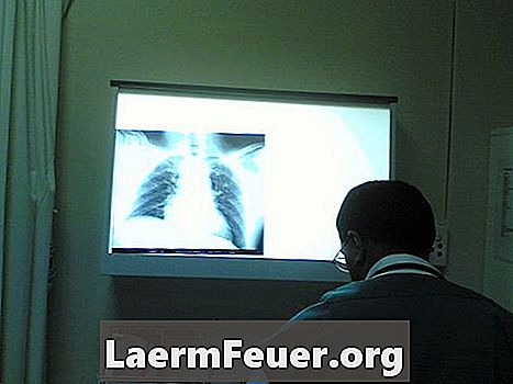 Дали nebulization се счита за кислородна терапия?