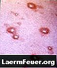 Zovirax è usato per trattare la varicella?