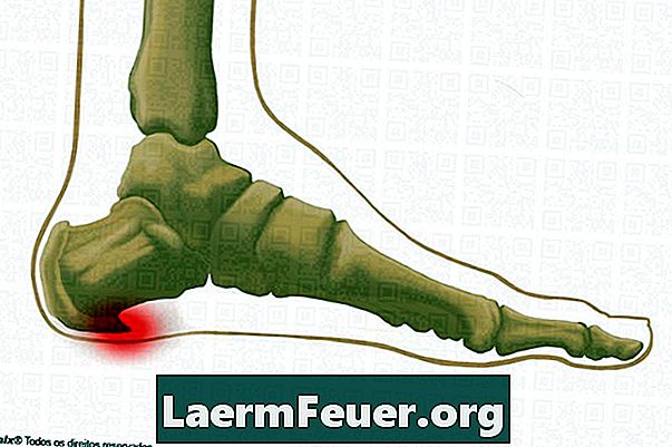 外反母趾の長い屈筋腱の痛みの軽減