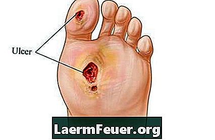 Con lo que una úlcera en el pie se parece?