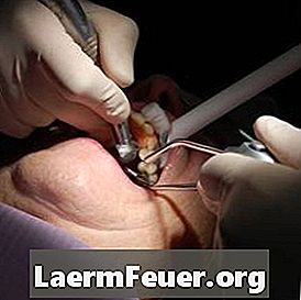 Kā izārstēt periodonta slimību bez operācijas?