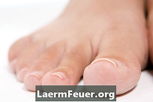 Comment guérir les callosités dans votre pied