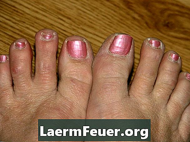 Hvordan kurere nagelsvamp og fortsatt ha sandaler