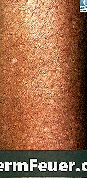 Hvordan skelne vitiligo fra en svampeinfektion