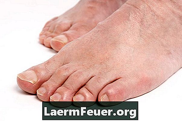 Come prevenire l'amputazione del piede a causa di lesioni e problemi di afflusso di sangue