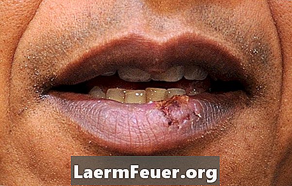 Hogyan lehet azonosítani a herpesz szimplexet okozó allergiákat?