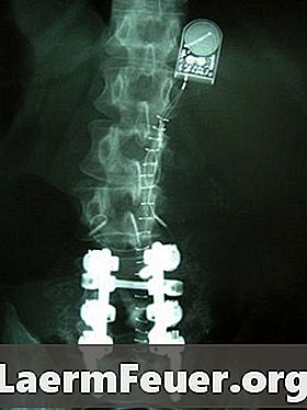 כיצד לפרש תוצאות MRI של עמוד השדרה הצווארי