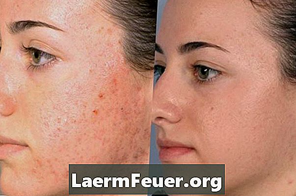 Hoe acne littekens van het gezicht te verwijderen