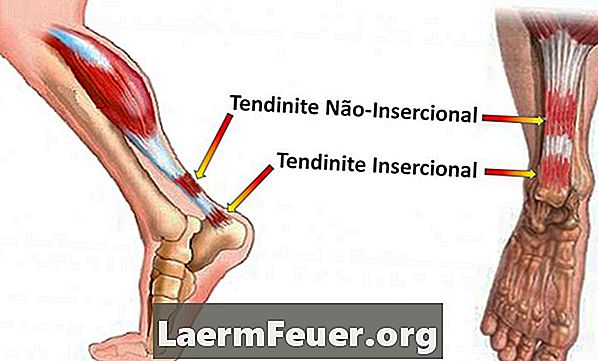 Comment savoir si le tendon est cassé