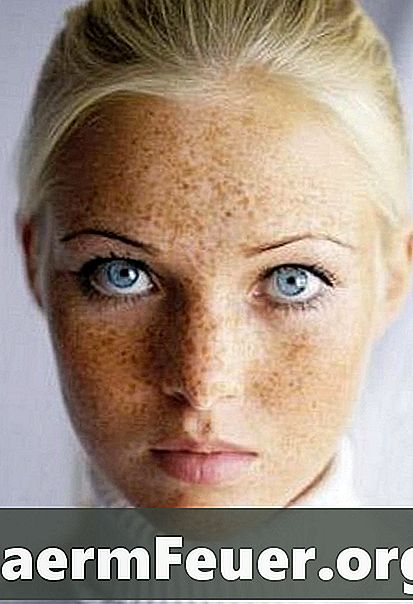 Bagaimana untuk menghilangkan freckles disebabkan oleh matahari di atas kaki