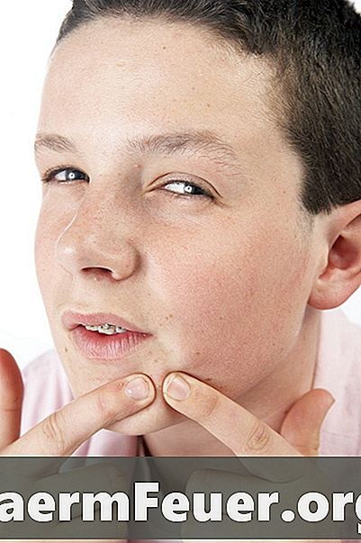 Como usar pomada para cicatriz de acne?