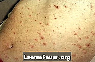 Comment lisser les cicatrices de varicelle