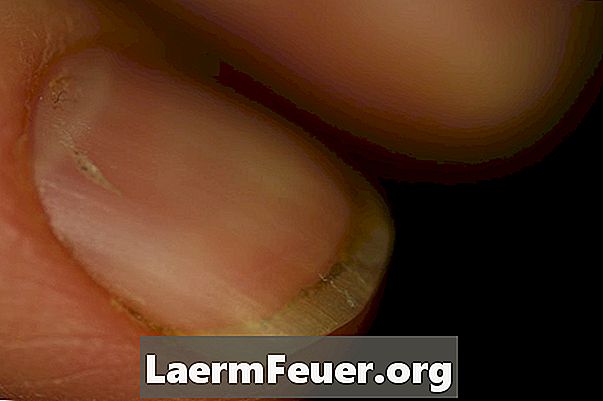 O que causa ondulações nas unhas?