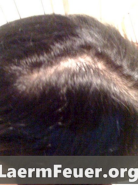 Jak przyjmować beta-sitosterol w celu zwalczania wypadania włosów