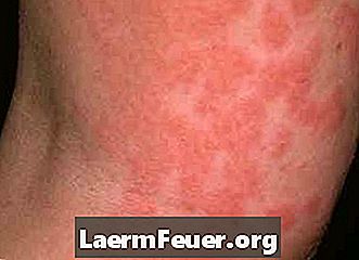 Kako liječiti svrbež uzrokovan alergijskom reakcijom na laktobacile