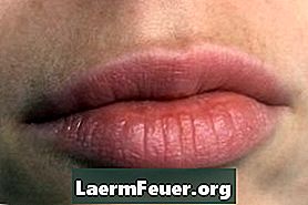 Behandlung von rissigen oder ausgetrockneten Lippen