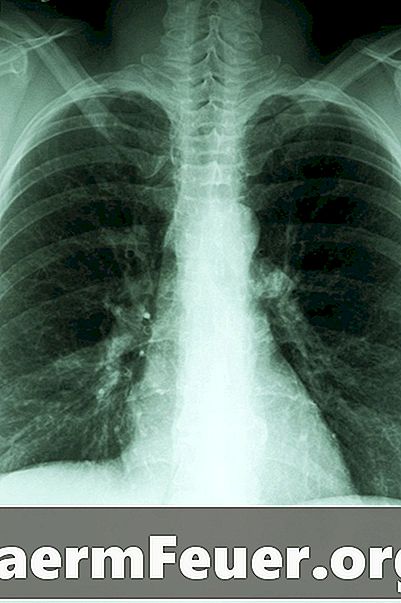 כיצד זיהום סטאף גורם לדלקת ריאות?