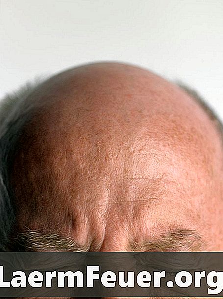 كيفية استخدام زيت الخروع لعلاج تساقط الشعر