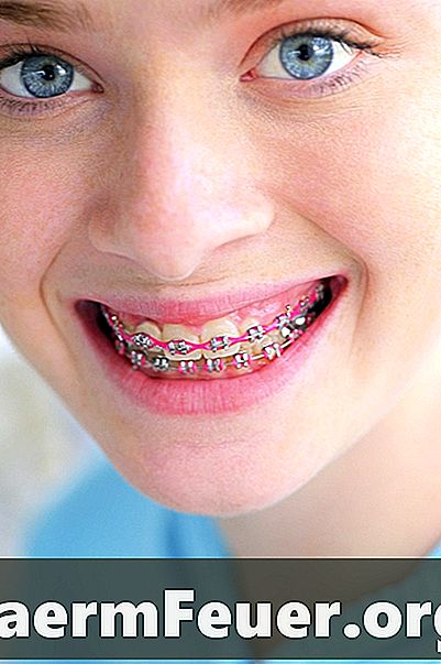 Displasia dentinária em crianças