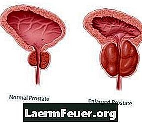 Nebenwirkungen der Laser-Prostata-Chirurgie
