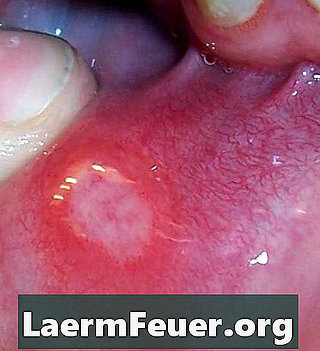 Opryszczkowe zapalenie jamy ustnej u dorosłych