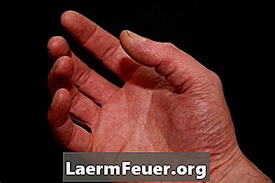 Övningar för händerna efter en karpaltunnkirurgi
