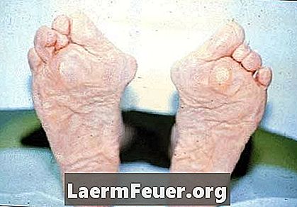 Hva forårsaker alvorlig smerte i føttens såler?