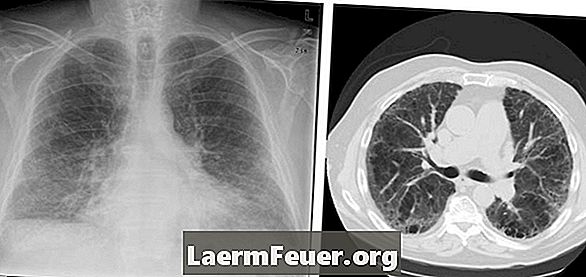 Hva er peri-hilar fibrosis av lungen