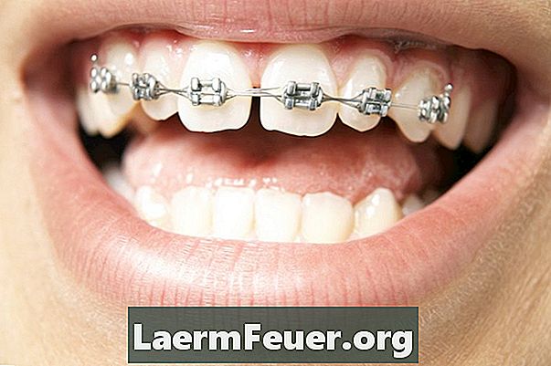 Co powoduje białe plamy na zębach?