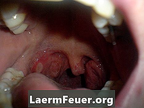 O que são tonsilas hipertróficas?