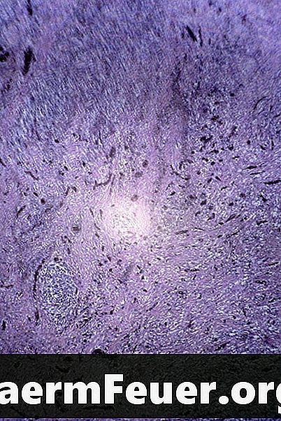 Hvad er et in situ carcinom af en pladecelle?