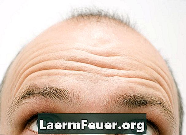 Fungerar Rogaine för frontal baldness?