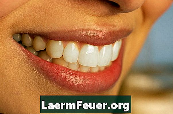 Могу ли се предњи зуби замијенити денталним имплантатима?