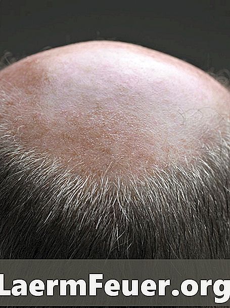 Koji su problemi skalpa uobičajeni u starijih osoba?
