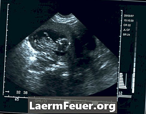 Kako prebrati poročila o Fetalni Ultrasonografiji