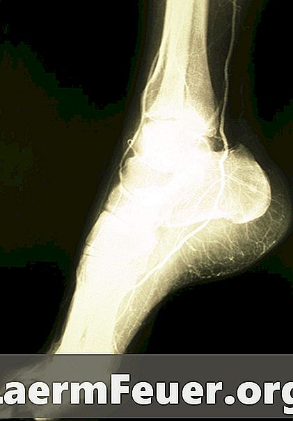 골절 된 발목이 치료되는 데는 얼마나 걸립니까?