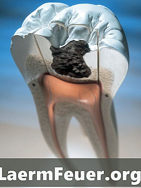 Tecken på ruttande tänder