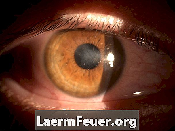 Sintomi di edema corneale