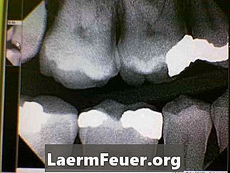 סינוסיטיס חוזרים הסימפטומים: כאב שיניים ולסת
