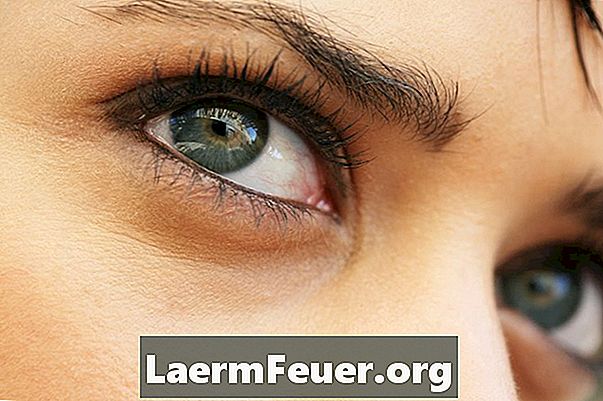 Como se livrar de olheiras alérgicas