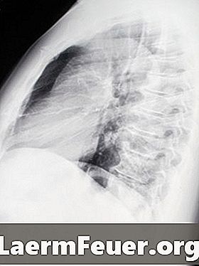 Jenis-jenis Lead Aprons untuk Perlindungan X-ray