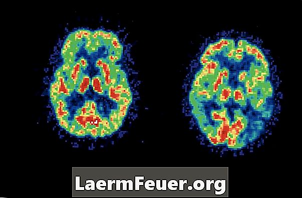 Hur länge bor de flesta patienter med allvarlig Alzheimers sjukdom på sjukhuset?