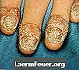 Leczenie łuszczycy paznokci (paznokci)