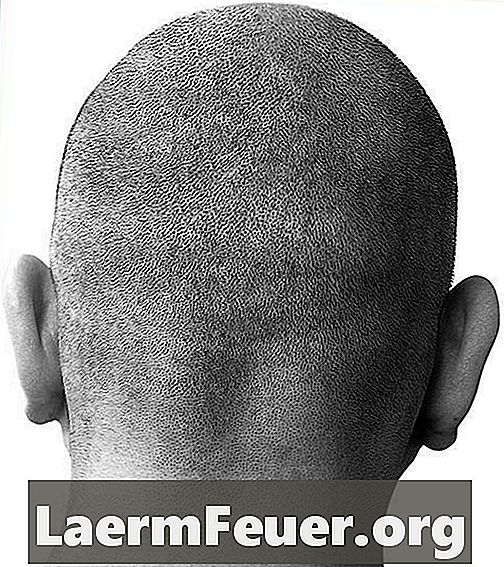 Tratamentos com esteroide para alopecia areata