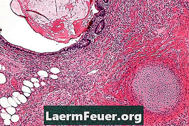 Tumor fibroso ovariano