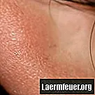 Cómo usar agua tibia para tratar un quiste del lóbulo de la oreja