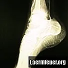 ¿Cuánto tiempo tarda en sanar una fractura de tobillo?